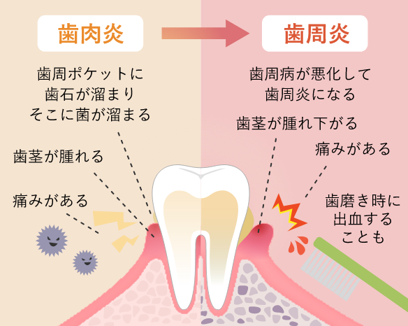 歯周病治療の移動イメージ
