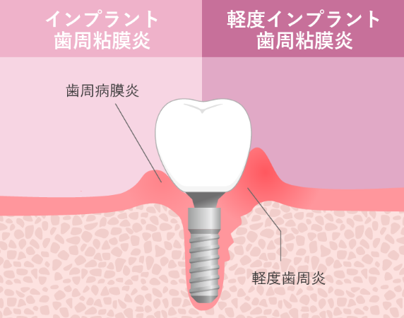 インプラント歯周粘膜炎イメージ