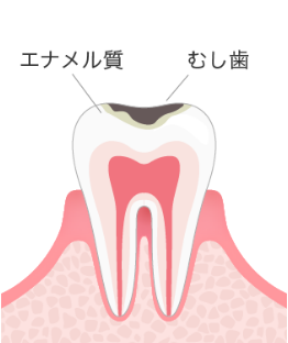 むし歯治療のC1イメージ