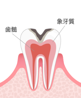 むし歯治療のC2イメージ