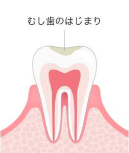 むし歯治療の初期虫歯イメージ