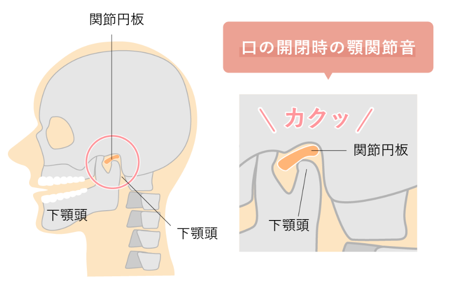 顎関節症の仕組みの画像