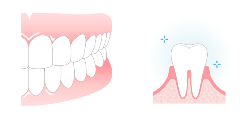 歯周病治療の健康な歯イメージ