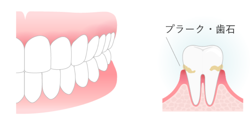 歯周病治療の軽度歯肉炎イメージ