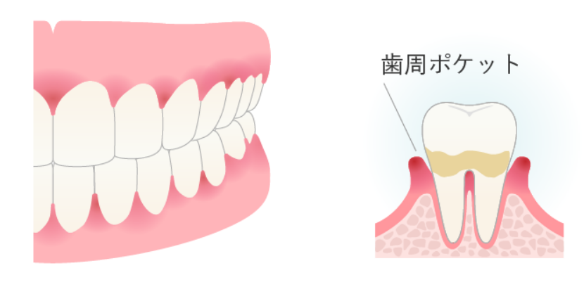 歯周病治療の重度歯肉炎イメージ
