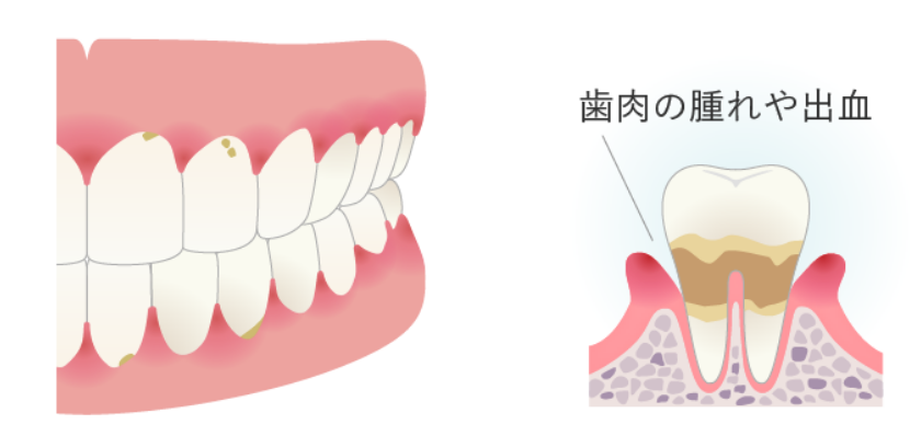 歯周病治療の中度歯周炎イメージ