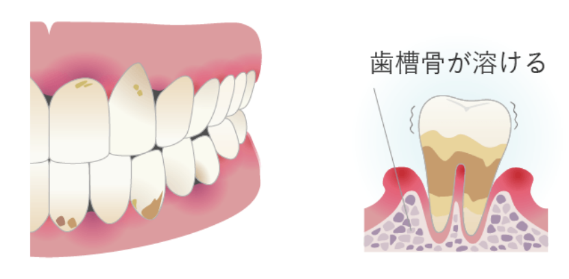 歯周病治療の重度歯周炎イメージ