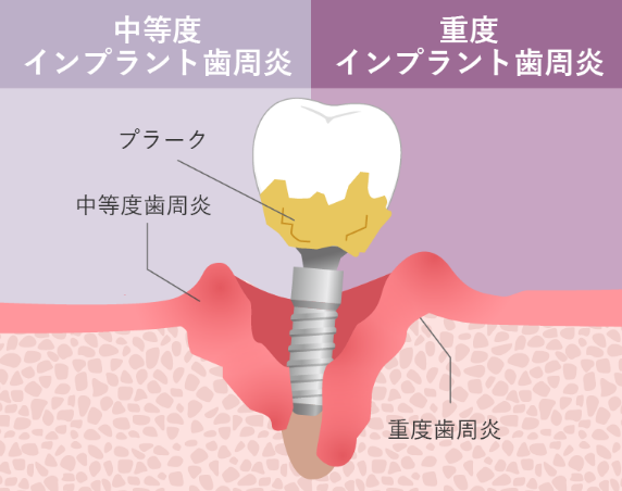 インプラント歯周炎イメージ