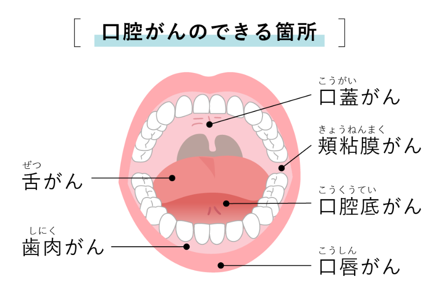 口腔がんのできる箇所